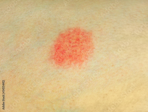 Photo: Skin disease Skin disease