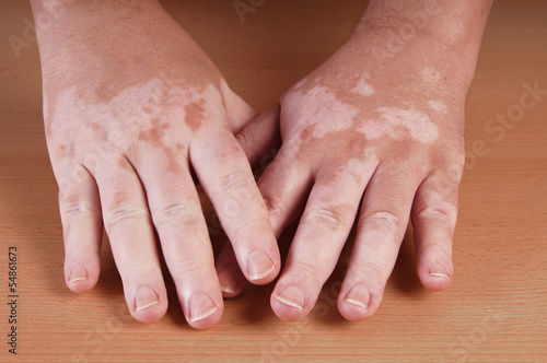 Photo: Vitiligo Vitiligo