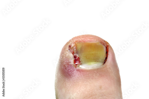 Photo: Ingrown toenail Ingrown toenail