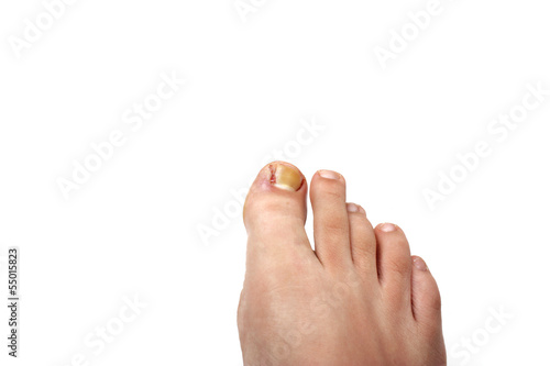 Photo: Removed ingrowing toe nail Removed ingrowing toe nail