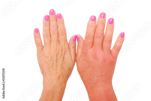 Photo: Swollen hand Swollen hand