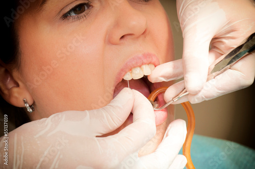 Photo: Nerve extraction Nerve extraction