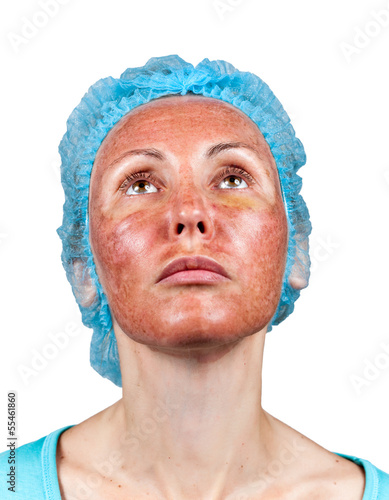 Photo: Cosmetology.Chemical peeling.Boundary between processed Cosmetology.Chemical peeling.Boundary between processed