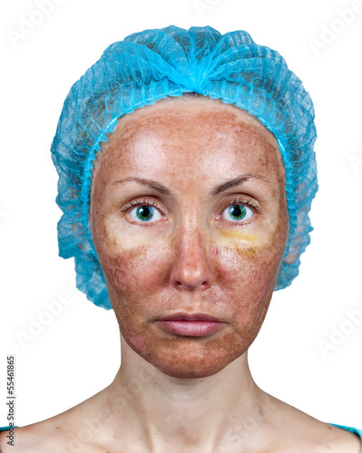 Photo: Cosmetology.Chemical peeling.Parchment skin before rejection Cosmetology.Chemical peeling.Parchment skin before rejection