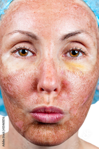 Photo: Chemical peeling. "Parchment" skin before rejection Chemical peeling. "Parchment" skin before rejection