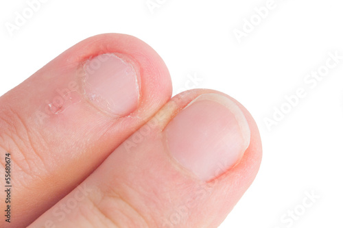 Photo: Fingernägelkauen Fingernägelkauen