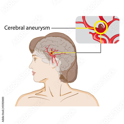 Vector: Cerebral aneurysm Cerebral aneurysm