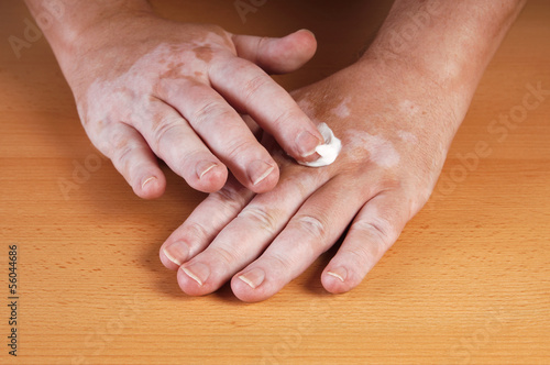 Photo: Vitiligo Vitiligo