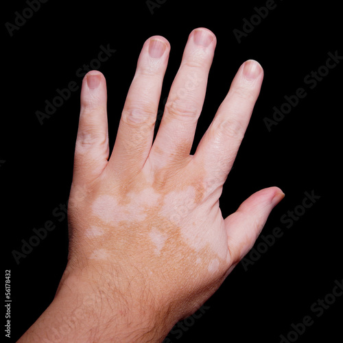 Photo: Vitiligo Vitiligo