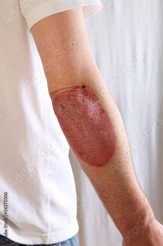 Photo: Person suffering from psoriasis Person suffering from psoriasis