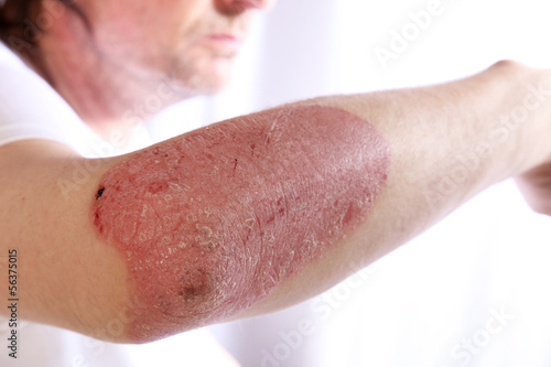 Photo: Person with plaque psoriasis of the arm Person with plaque psoriasis of the arm