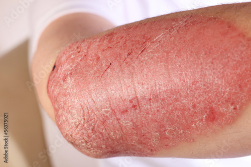 Photo: Plaque psoriasis Plaque psoriasis