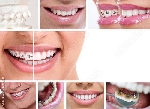 Photo: dental braces dental braces