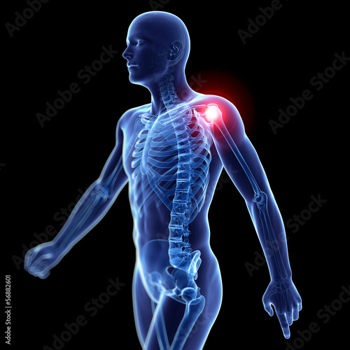 Illustration: 3d rendered illustration of a painful shoulder 3d rendered illustration of a painful shoulder