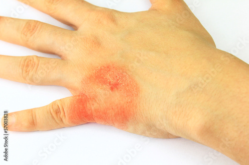 Photo: Skin disease Skin disease