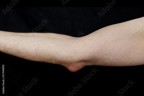 Photo: Olecranon bursitis, also known as student’s elbow Olecranon bursitis, also known as student’s elbow