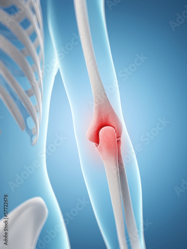 Illustration: inflamed elbow inflamed elbow