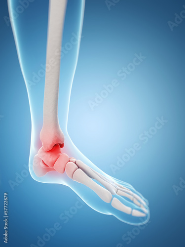 Illustration: inflamed ankle inflamed ankle