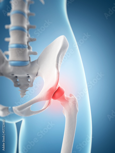 Illustration: inflamed hip joint inflamed hip joint