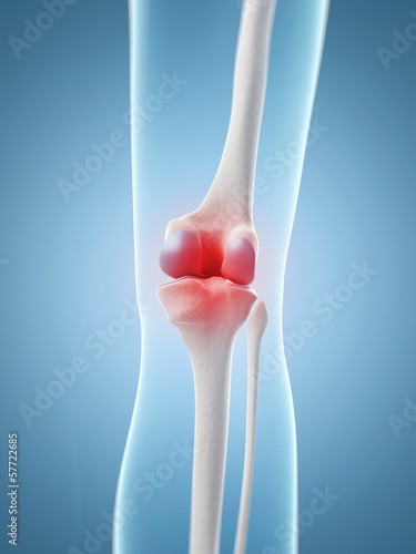 Illustration: inflamed knee joint inflamed knee joint