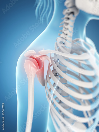 Illustration: inflamed shoulder joint inflamed shoulder joint