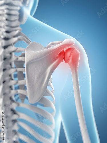 Illustration: inflamed shoulder joint inflamed shoulder joint