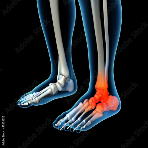 Illustration: Human foot pain with the anatomy of a skeleton foot Human foot pain with the anatomy of a skeleton foot