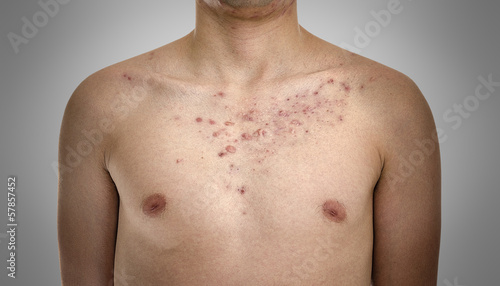 Photo: Acne, scars and keloids in the chest of a young man. Acne, scars and keloids in the chest of a young man.