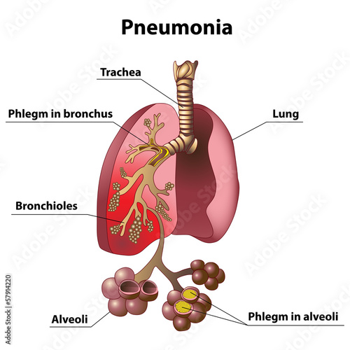 Vector: pneumonia pneumonia