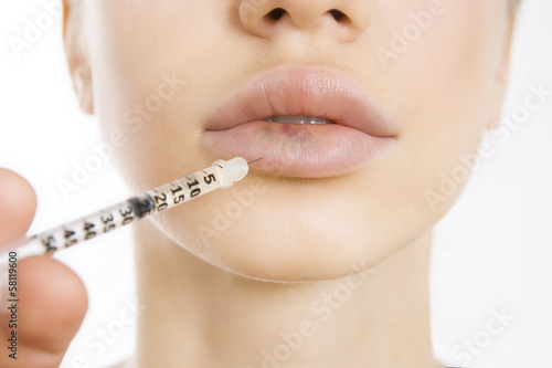 Photo: real lip bruise after injection real lip bruise after injection