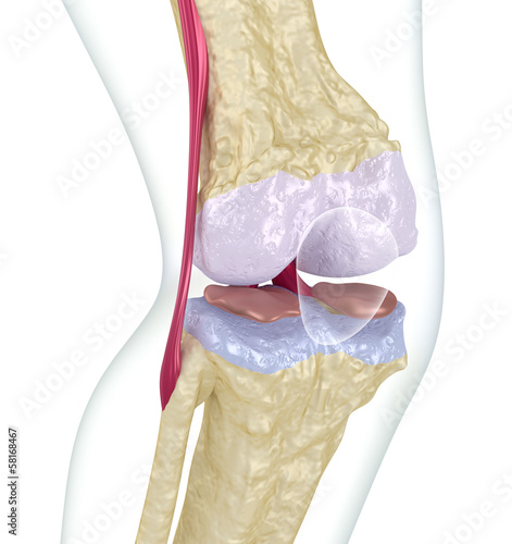 Illustration: Osteoporosis of the knee joint. Osteoporosis of the knee joint.
