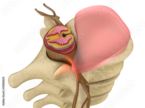 Illustration: Prolapse of intervertebral disc closeup Prolapse of intervertebral disc closeup