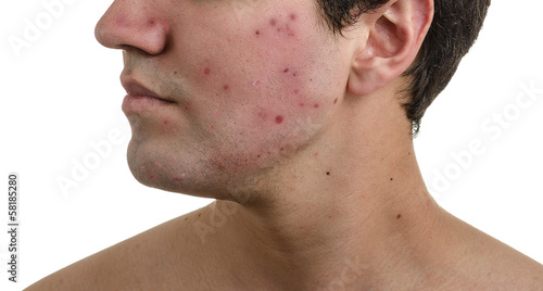 Photo: Acne, scars and keloids in the face of a man. Acne, scars and keloids in the face of a man.