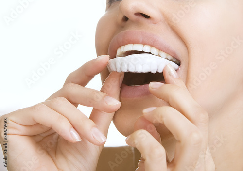 Photo: teeth Whitening - smiling girl with tooth tray teeth Whitening - smiling girl with tooth tray