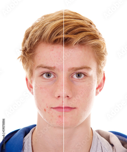 Photo: Teenager mit unreiner Haut | vorher – nachher Teenager mit unreiner Haut | vorher – nachher
