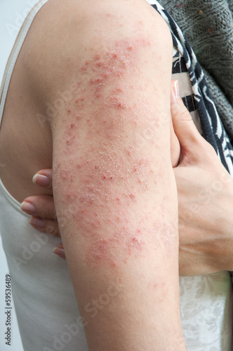 Photo: allergic rash dermatitis allergic rash dermatitis