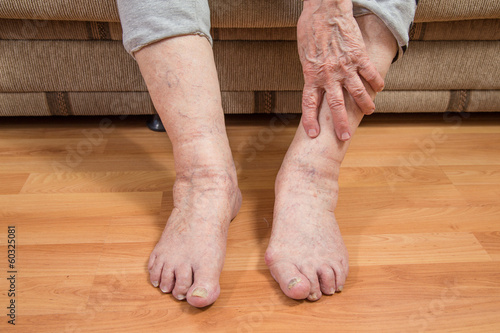 Photo: damaged toes and wrinkled hand damaged toes and wrinkled hand
