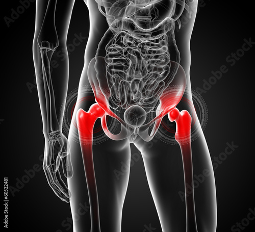 Illustration: 3d rendered, medical illustration of a painful hip joint -front 3d rendered, medical illustration of a painful hip joint -front