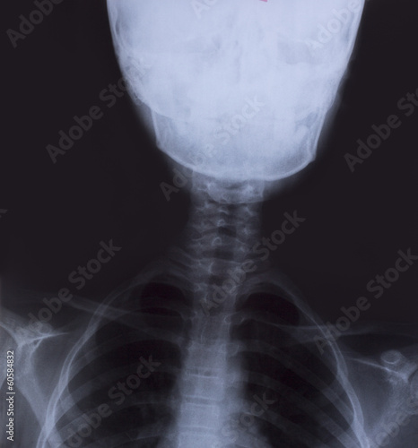 Photo: detail of neck and head x-ray image detail of neck and head x-ray image