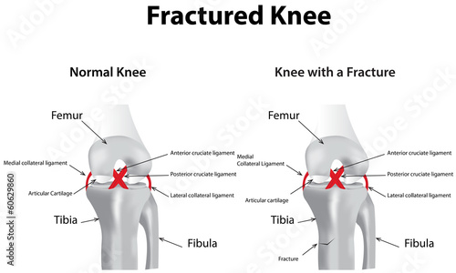 Illustration: Fractured Knee Fractured Knee