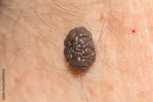 Photo: a mole on the skin. macro a mole on the skin. macro