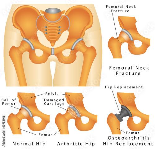 Vector: Hip joint. Arthritic Hip. Hip fracture Hip joint. Arthritic Hip. Hip fracture