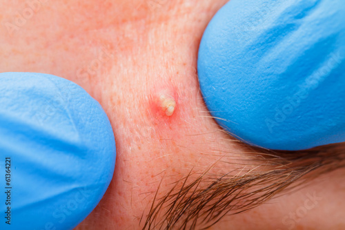 Photo: Acne skin Acne skin