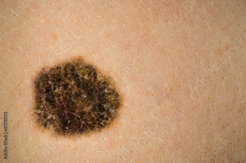 Photo: Melanoma, Mole, Skin Cancer. High definition image. Melanoma, Mole, Skin Cancer. High definition image.