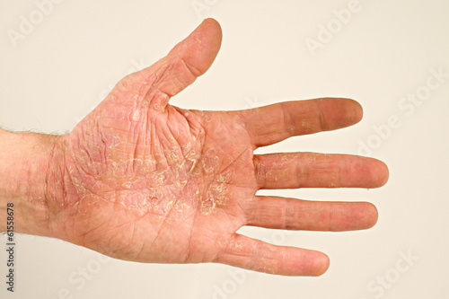 Photo: li. Hand 831 Neurodermitis li. Hand 831 Neurodermitis
