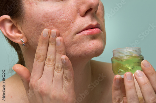 Photo: Acne therapy Acne therapy