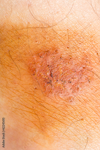 Photo: sore on the skin. macro sore on the skin. macro
