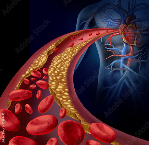 Illustration: Clogged Artery Clogged Artery