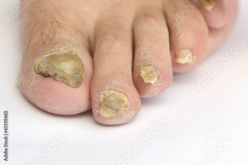 Photo: Toenail Fungus Toenail Fungus