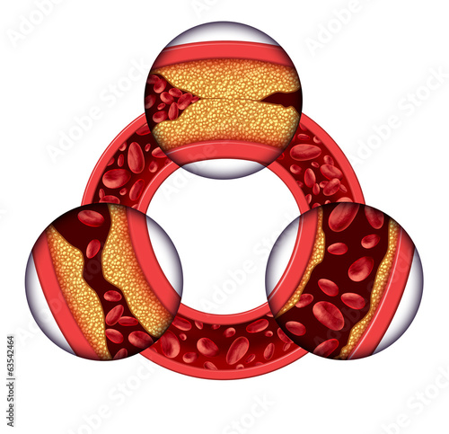 Illustration: Coronary Artery Disease Coronary Artery Disease